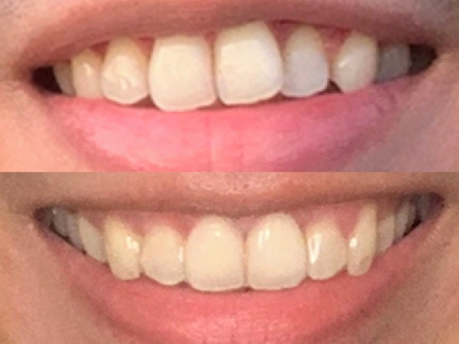 Zenyum Clear Aligners Review | Before and After invisible braces