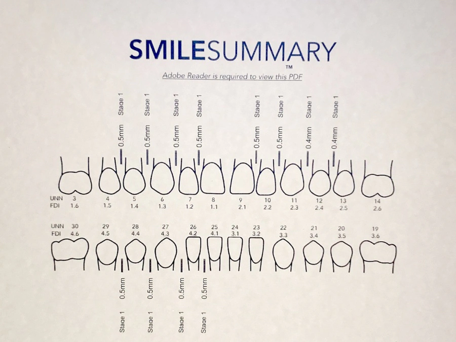 Zenyum Singapore Review Clear Aligners | Smile Summary